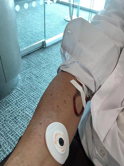 man's arm with his sleeve rolled up with a drip that can just be seen