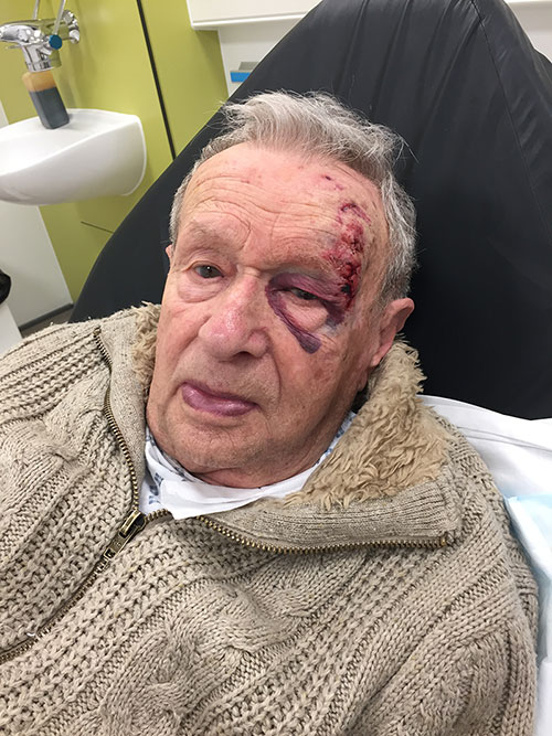 elderly man with cuts and bruises to his head and around his eye